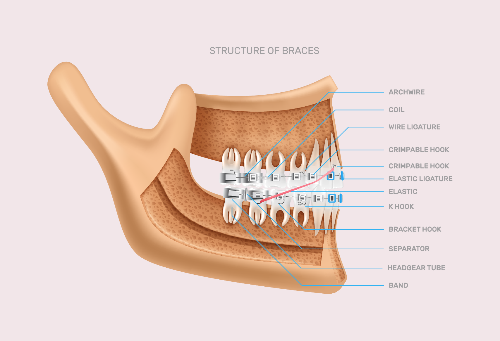 The Parts Of Braces